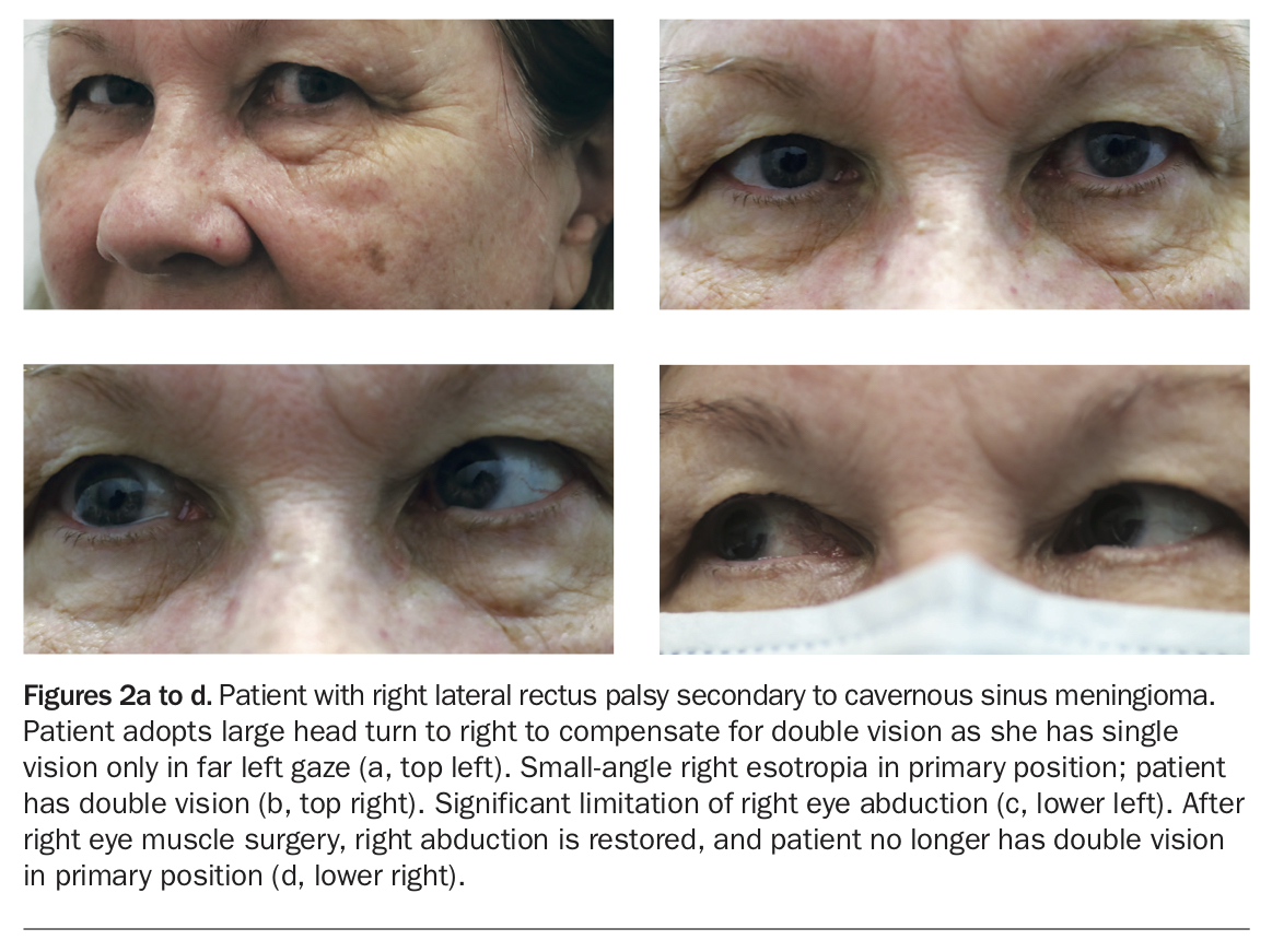 Strabismus What Gps Need To Know Medicine Today